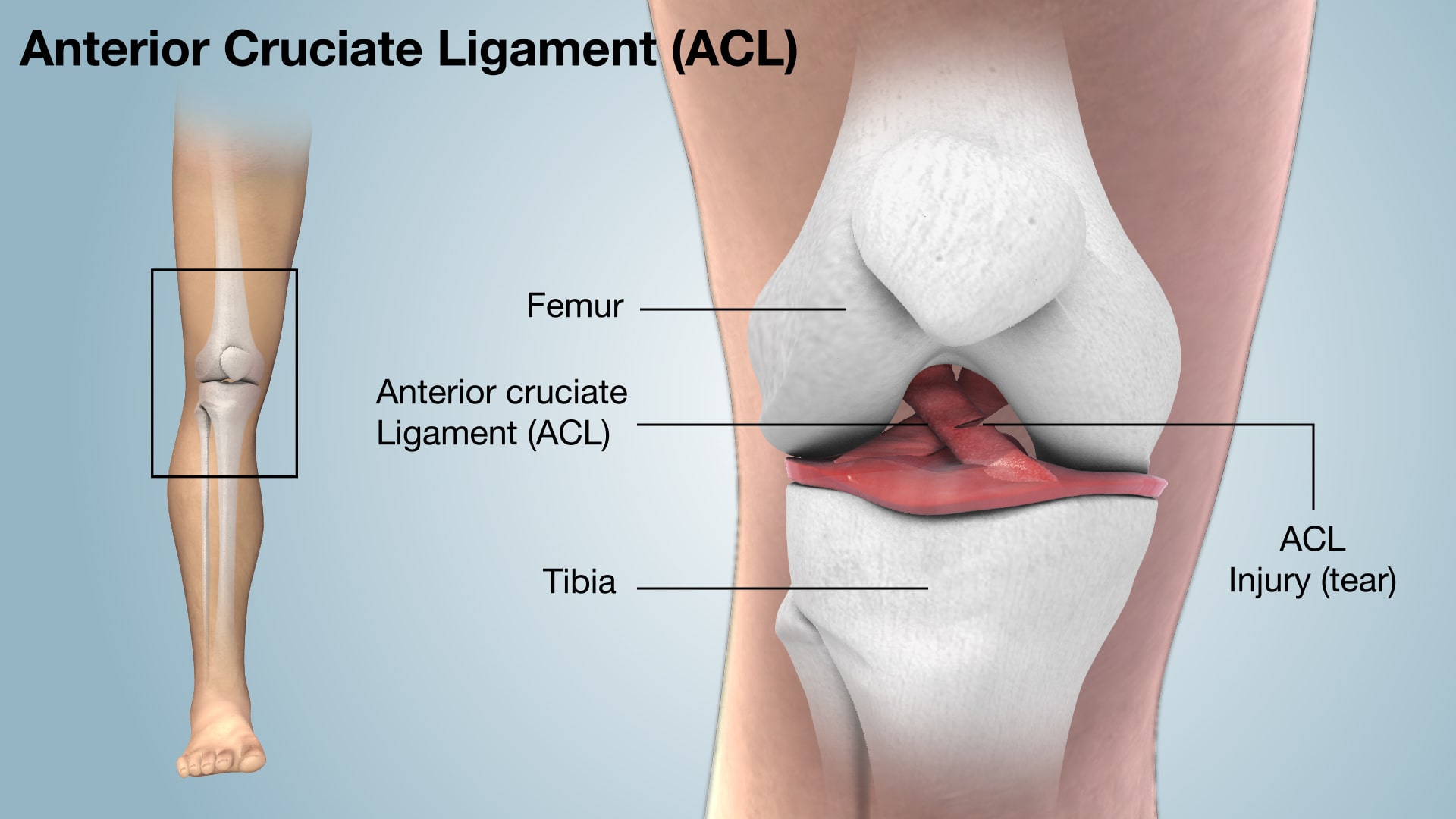 What is ACL tear