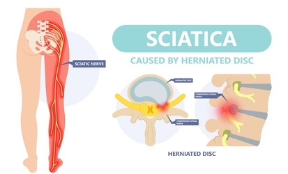Sciatica Pain Relief Treatment Braces for Pinched Nerve