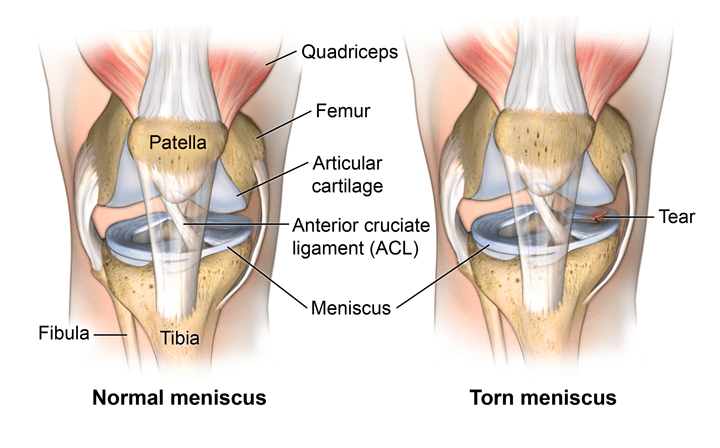 knee brace for a meniscus tear