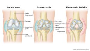 Osteoarthritis knee