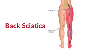 Sciatica causing back pain 