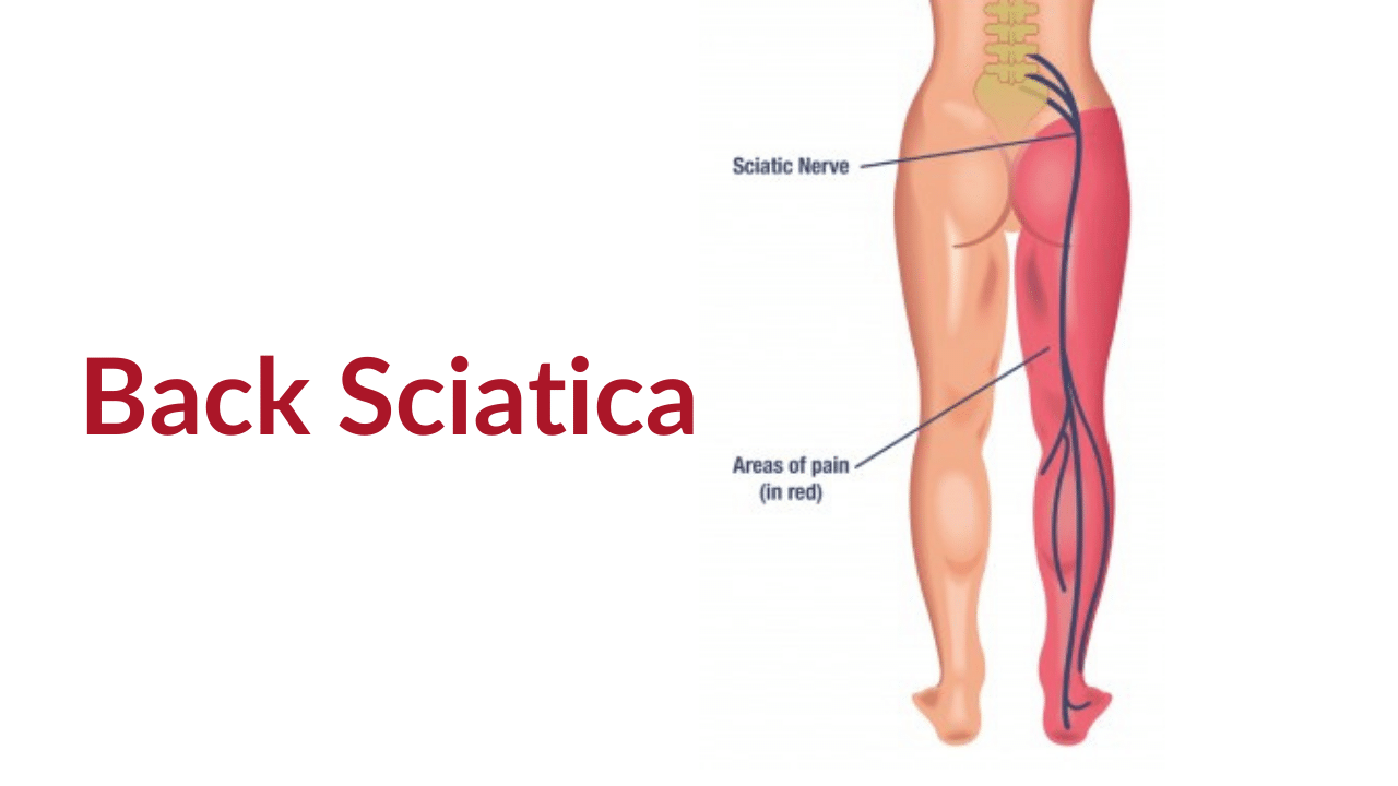 Is Your Back Pain Sciatica? How to Identify and Treat It – DAPHCO ...