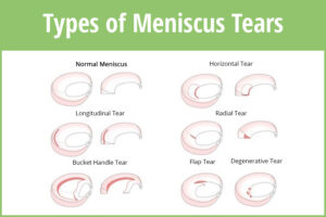 Types of Meniscus tears
