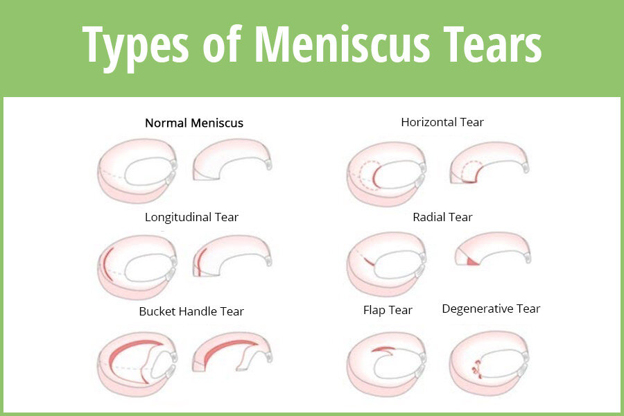 Types of Meniscus Tears - DAPHCO - Medical Equipment