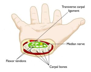 Understanding Carpal Tunnel Syndrome - DAPHCO - Medical Equipment