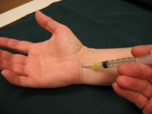 Steroid injection for carpal tunnel syndrome